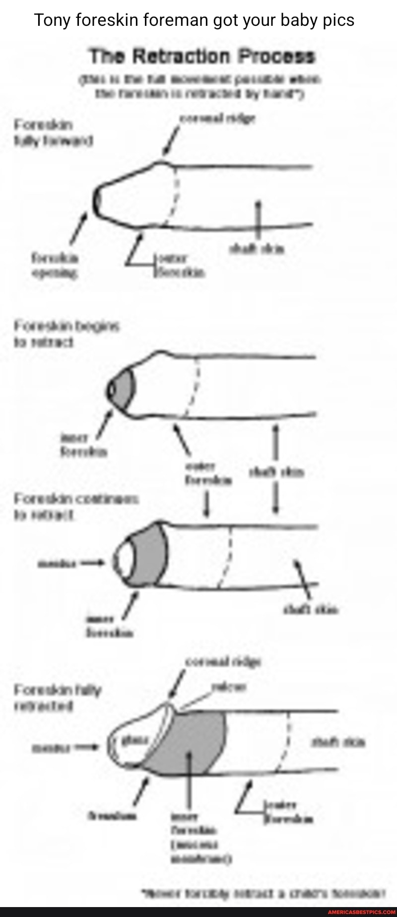Tony Foreskin Foreman Got Your Baby Pics The Retraction Process Et Day tony-foreskin-foreman-got-your-baby-pics-the-retraction-process-et-day